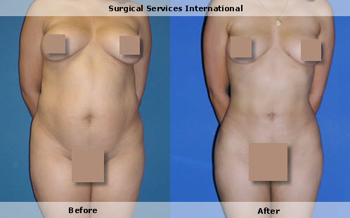Liposuction, fat removal